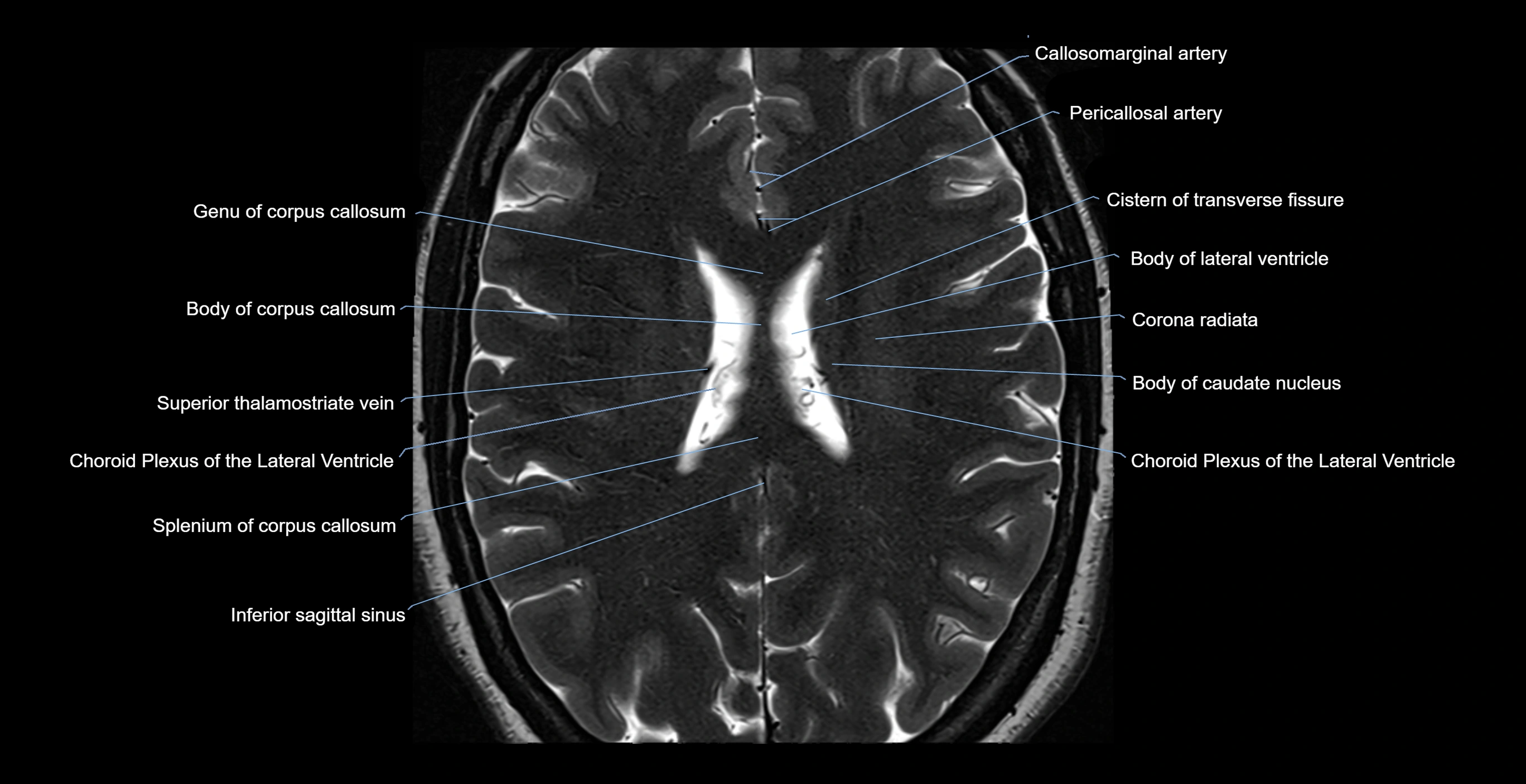 brain axial anatomy 3T MRI images -img-17001-00041.webp